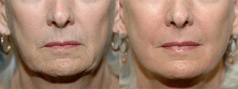 terapia laserowa przed i po
