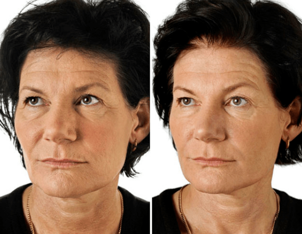 Wynik ułamkowego odmładzania twarzy