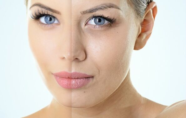 Wskazania do odmładzania ułamkowego