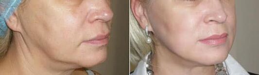 Zdjęcie po zastosowaniu procedury